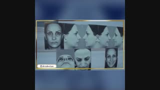 فیلم جراحی سپتوپلاستی ثانویه