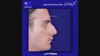 عمل رینوپلاستی بینی استخوانی