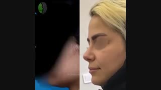 جراحی بینی اولیه به فرم نیمه فانتزی | دکتر باستانی نژاد