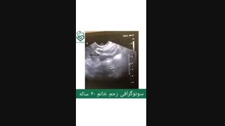 سونوگرافی رحم در خانم ۴۰ ساله