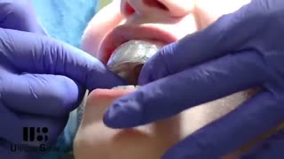 ارتودنسی نامرئی با استفاده از الاینرهای شفاف (پلاک های شفاف) | دکتر لیلا عطایی