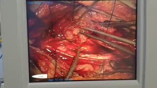 فیلم تومور نخاع گردن