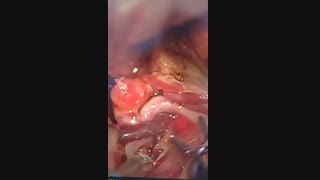 عمل آنوریسم مغزی