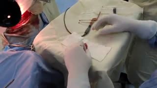 فیلم عمل بیمار با تومور جنینی