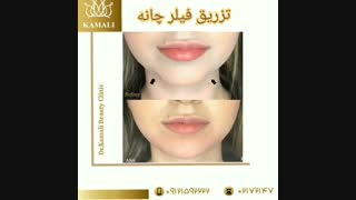 فیلم واقعی تزریق به چانه