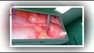 فیلم برداشت کیست آندومتریوما با لاپاراسکوپ