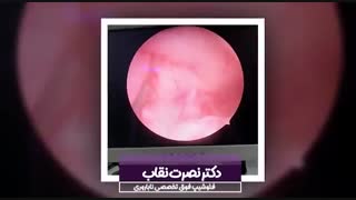 فیلم جراحی هیستروسکوپی برداشت سپتوم رحمی قبل از ivf