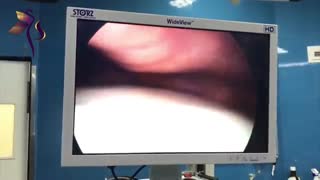 جراحی لاپاراسکوپی کیست تخمدان در نوجوان 16 ساله