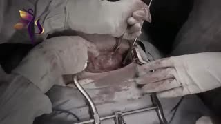 جراحی میومکتومی فیبروم بزرگ 14 سانتی