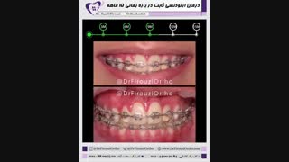 درمان ارتودنسی ثابت در بازه زمانی ۱۵ ماهه | دکتر فاضل فیروزی