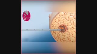 مارکرگذاری تومور پستان