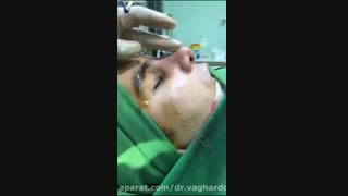 فیلم جراحی انحراف بینی