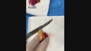 بزرگ کردن پستان با تزریق روغن سویا ممنوع