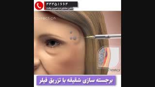 برجسته سازی شقیقه با فیلر
