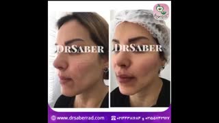 تزریق فیلر به گونه و لب