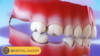 چرا باید جای خالی دندان را پر کنیم؟