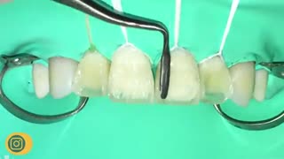 ویژگی کامپوزیت نانوسرامیک چیست؟