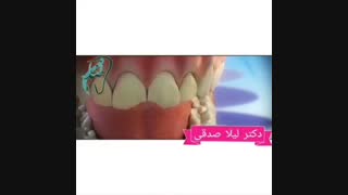 لمینت دندان