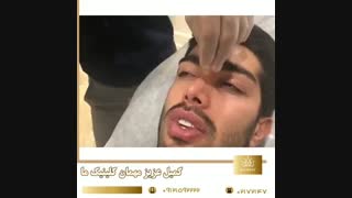 فیلم واقعی رینوپلاستی با تزریق فیلر