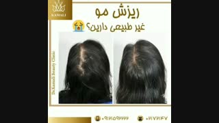 فیلم درمان ریزش مو غیر طبیعی