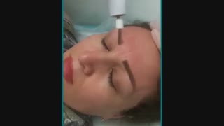 فیلم میکرودرم صورت در کلینیک دکتر خدایاری
