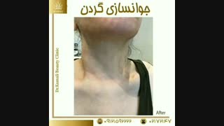 فیلم واقعی جوانسازی گردن