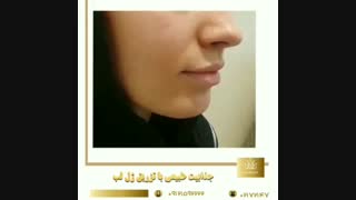فیلم واقعی جذابیت طبیعی با تزریق ژل لب