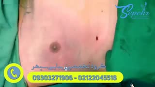 فیلم ژنیکوماستی دوطرفه و غیرقرینه