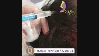 فیلم واقعی مزوتراپی مو