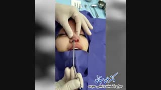 فیلم تخلیه ژل بینی و بازسازی بینی