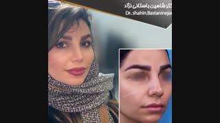 نمونه جراحی بینی دکتر باستانی نژاد | جراح بینی تهران