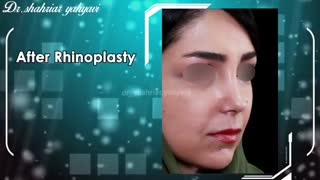 قبل و بعد از جراحی بینی | دکتر یحیوی