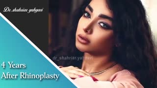 4 سال بعد از جراحی بینی | دکتر یحیوی