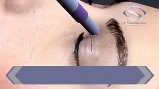 فیلم جراحی زیبایی پلک (بلفاروپلاستی)