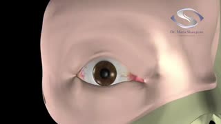 تیروئید چه تاثیری  بر چشم دارد؟