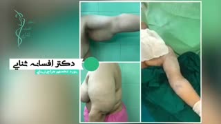 فیلم عمل براکیوپلاستی در بازوی شل و افتاده