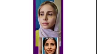 فیلم واقعی جراحی ترمیمی بینی و تغییر فرم از طبیعی به فانتزی