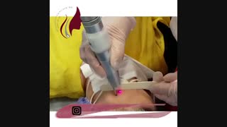 فیلم لیزر تاتوی ابرو