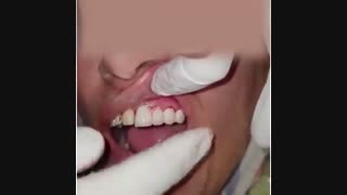 روکش و لمینت های زییایی دندان های قدام فک بالا