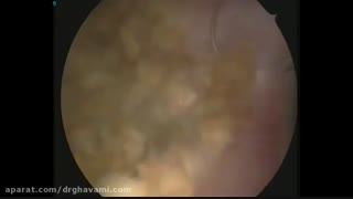 جراحی تومور سرطانی مثانه