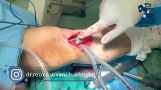 فیلم عمل زانوی پرانتزی