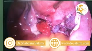 عمل لاپاراسکوپی خارج کردن فیبرم رحم