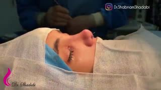 بلافاصله بعد از عمل بینی استخوانی با انحراف