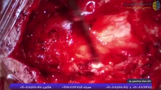 جراحی برداشت تومور نخاعی  موفقیت آن
