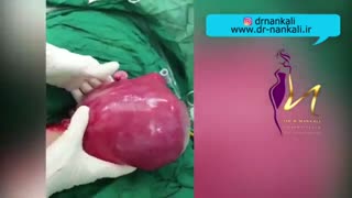 فیلم جراحی میومکتومی بدون خارج کردن رحم