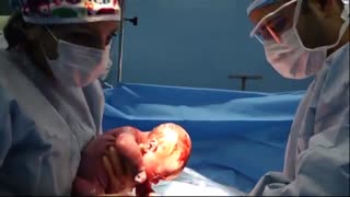 فیلم جراحی زایمان سزارین