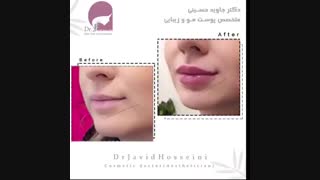 فیلم تزریق ژل لب طبیعی