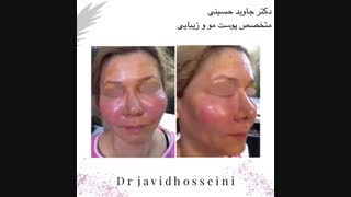 فیلم لیپوترانسفر یا نانوفت