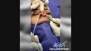فیلم مشکلات تزریق کلسیم به بینی