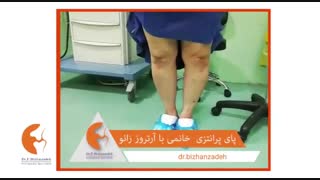 فیلم عمل جراحی اصلاح پای پرانتزی